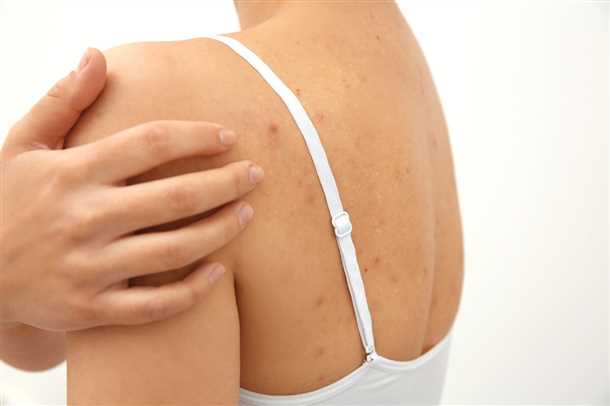 Правила использования средств с салициловой кислотой: